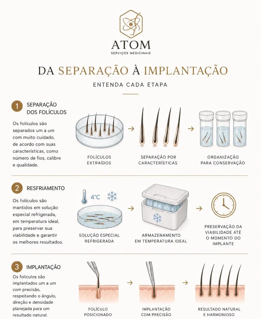 Infográfico sobre separação, resfriamento e implantação dos folículos capilares